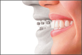Invsialign from Dr. Robert Panzer, Orthodontist